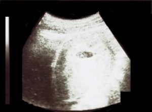 エコー画像妊娠6週　双子女子とこそだて