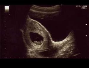 エコー画像妊娠8週　双子女子とこそだて