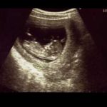 エコー画像妊娠12週　双子女子とこそだて