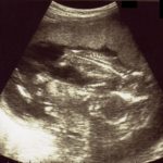 エコー画像妊娠15週　双子女子とこそだて