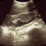 エコー画像妊娠18週　双子女子とこそだて