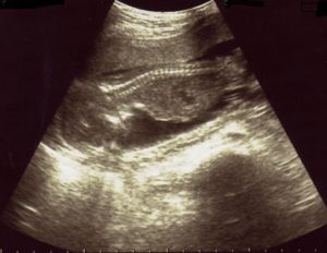 エコー画像妊娠18週　双子女子とこそだて