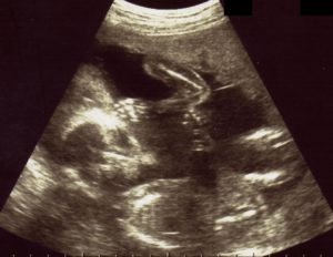 エコー画像妊娠21週