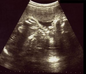 エコー画像妊娠28週　双子女子とこそだて