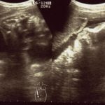 エコー画像妊娠31週　双子女子とこそだて
