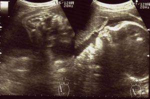 エコー画像妊娠31週　双子女子とこそだて