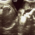 エコー画像妊娠36週　双子女子とこそだて