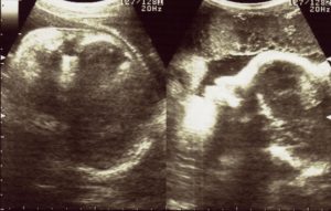 エコー画像妊娠36週　双子女子とこそだて